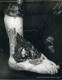Sans titre (pied amputé) Sans titre (pied amputé)